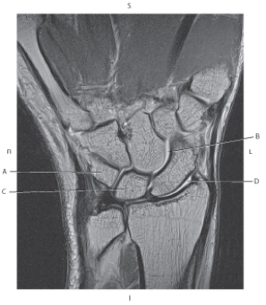 The following questions refer to the figure below of a coronal, T2-weighted MRI of the wrist.   -Which line points to the radiocarpal joint? A)  A B)  B C)  C D)  D