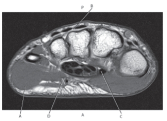 The following questions refer to the figure below of an axial, T1-weighted MRI of the wrist.   -Which line points to the extensor retinaculum? A)  A B)  B C)  C D)  D