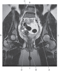 The following questions refer to the figure below of a coronal, T1-weighted MRI of the female pelvis.   -Which line points to the vagina? A)  A B)  B C)  C D)  D