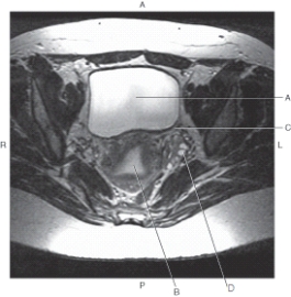 In the figure below of an axial, T2-weighted MRI of the female pelvis, which line points to the left ovary?   A)  A B)  B C)  C D)  D