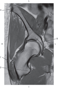The following questions refer to the figure below of a coronal, T1-weighted MRI of the right hip.   -Which line points to the lesser trochanter? A)  A B)  B C)  C D)  D