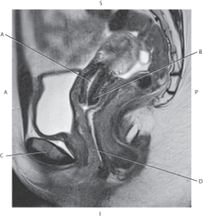The following questions refer to the figure below of a sagittal, T2-weighted MRI of the female pelvis.   -Which line points to the uterine cavity? A)  A B)  B C)  C D)  D