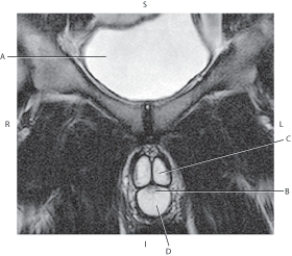 The following questions refer to the figure below of a coronal, T2-weighted MRI of the penis.   -Which line points to the penile urethra? A)  A B)  B C)  C D)  D