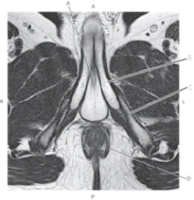 The following questions refer to the figure below of an axial, T2-weighted MRI of the male pelvis.   -Which line points to the ischiopubic ramus? A)  A B)  B C)  C D)  D