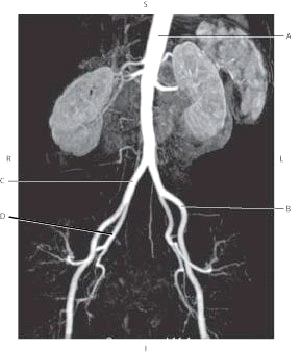 The following questions refer to the figure below of an MRA of the descending aorta.   -Which line points to the abdominal aorta? A)  A B)  B C)  C D)  D