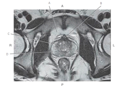 The following questions refer to the figure below of an axial, T2-weighted MRI of the male pelvis.   -Which line points to the central zone of the prostate? A)  A B)  B C)  C D)  D