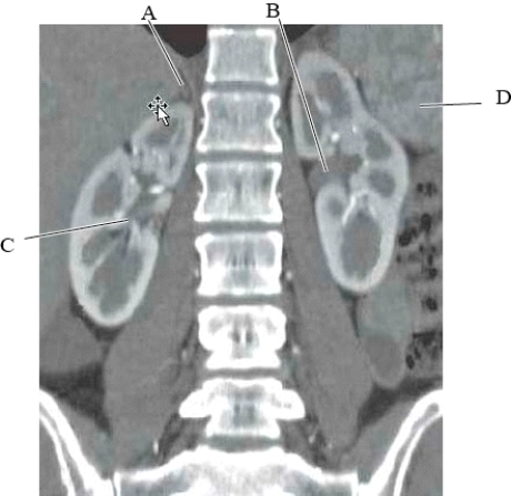 The following questions refer to the figure below of a coronal CT reformat of the abdomen.   -Which line is pointing to the left renal pelvis? A)  A B)  B C)  C D)  D