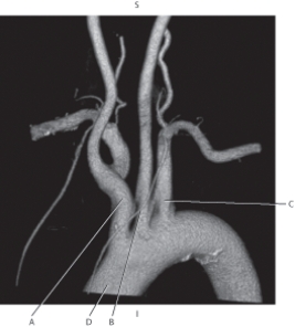 The following questions refer to the figure below of a 3D CT of the aortic arch.   -Which line points to the brachiocephalic trunk? A)  A B)  B C)  C D)  D