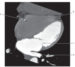 The following questions refer to the figure below of a horizontal long axis CT.   -Which line points to the left anterior descending artery? A)  A B)  B C)  C D)  D