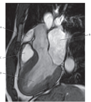 The following questions refer to the figure below of a T2-weighted MRI of the left ventricular outflow tract.   -Which line points to the right ventricle? A)  A B)  B C)  C D)  D