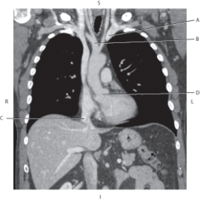 The following questions refer to the figure below of a coronal CT reformat thorax.   -Which line points to the root of the aorta? A)  A B)  B C)  C D)  D