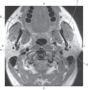 In the figure below of an axial, T1-weighted MR of the neck, which arrow points to the medial pterygoid muscle?   A)  A B)  B C)  C D)  D