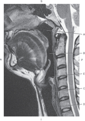 The following questions refer to the figure below of a midsagittal, T2-weighted MRI of the neck.   -Which arrow points to the oropharynx? A)  A B)  B C)  C D)  D E)  E