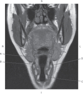 The following questions refer to the figure below of a coronal, T1-weighted MRI of the neck.   -Which arrow points to the thyroid cartilage? A)  A B)  B C)  C D)  D