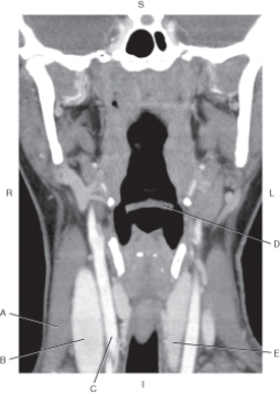 The following questions refer to the figure below of a coronal CT reformat of the neck.   -Which arrow points to the internal jugular vein? A)  A B)  B C)  C D)  D E)  E