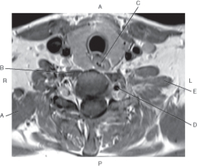 The following questions refer to the figure below of an axial, T1-weighted MRI of the neck.   -Which arrow points to the middle scalene muscle? A)  A B)  B C)  C D)  D E)  E