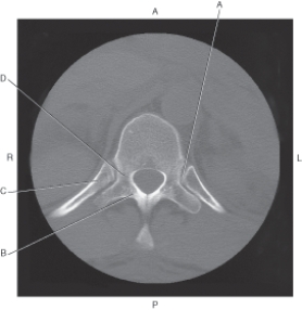 The following questions refer to the figure below of an axial CT of the thoracic vertebra.   -Which line points to the costovertebral joint? A)  A B)  B C)  C D)  D