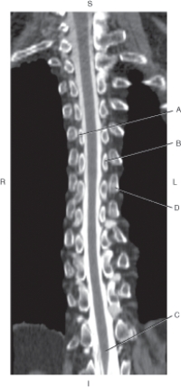The following questions refer to the figure below of a coronal CT reformat of the thoracic spine, with intrathecal contrast.   -Which line points to the medial end of rib? A)  A B)  B C)  C D)  D