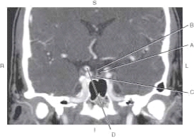 The following questions refer to the figure below of a coronal CT reformat.   -Which line points to the internal carotid artery? A)  A B)  B C)  C D)  D