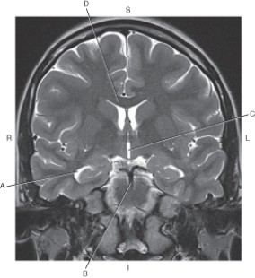 The following questions refer to the figure below of a coronal, T2-weighted MRI of the brain.   -Which line points to the third ventricle? A)  A B)  B C)  C D)  D