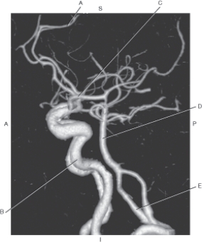 The following questions refer to the figure below of a lateral CTA of the cerebral arteries.   -Which line points to the internal carotid artery? A)  A B)  B C)  C D)  D E)  E