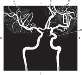 The following questions refer to the figure below of a coronal oblique MRA of the cerebral arteries.   -Which line points to the anterior communicating artery? A)  A B)  B C)  C D)  D