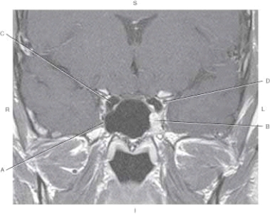 The following questions refer to the figure below of a coronal, T1-weighted MRI of the cavernous sinus with contrast enhancement.   -Which line points to the trigeminal nerve, maxillary division (CN V<sub>2</sub>) ? A)  A B)  B C)  C D)  D