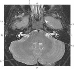 The following questions refer to the figure below of an axial, T2-weighted MRI of the brain.   -Which line points to cerebellum? A)  A B)  B C)  C D)  D E)  E