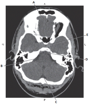 The following questions refer to the figure below of an axial CT of the brain.   -Which line points to the cerebellopontine angle (CPA)  cistern? A)  A B)  B C)  C D)  D E)  E