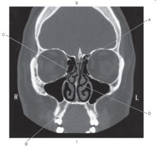 The following questions refer to the figure below of a coronal CT of the ethmoid bone.   -Which line points to the middle nasal meatus? A)  A B)  B C)  C D)  D