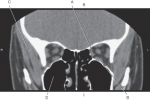 The following questions refer to the figure below of a coronal CT of the orbit.   -Which line points to the temporalis muscle? A)  A B)  B C)  C D)  D