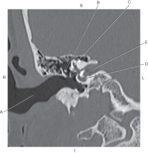 The following questions refer to the figure below of a coronal CT reformat of the inner ear.   -Which line points to the superior semicircular canal? A)  A B)  B C)  C D)  D E)  E
