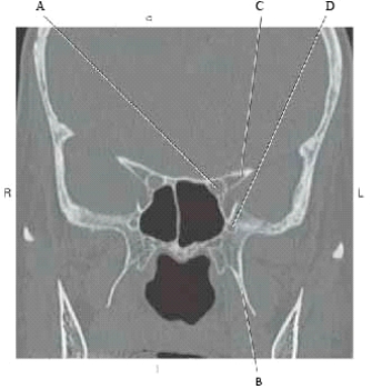 The following questions refer to the figure below of a coronal CT of the cranium.   -Which line points to the anterior clinoid process of sphenoid bone? A)  A B)  B C)  C D)  D
