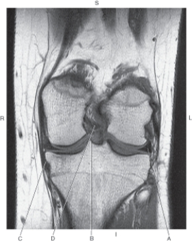 In the figure below of a coronal, T1-weighted MRI of the knee, which line points to the posterior cruciate ligament?   A)  A B)  B C)  C D)  D