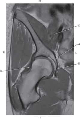 The following questions refer to the figure below of a coronal, T1-weighted MRI of the right hip.   -Which line is pointing to the acetabulum? A)  A B)  B C)  C D)  D