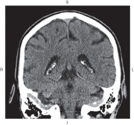 The figure below illustrates which of the following imaging planes?   A)  Axial B)  Coronal C)  Sagittal D)  Oblique