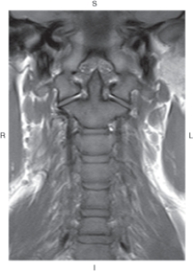 The figure below illustrates which of the following imaging planes?   A)  Axial B)  Coronal C)  Sagittal D)  Oblique