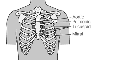   Explanation:  X should be placed over the dot indicated by the term mitral.