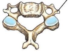 The bony part identified in this figure is the:   A)  spinous process. B)  transverse process. C)  pedicle. D)  lamina.