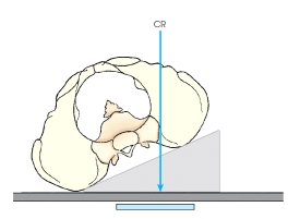 The projection demonstrated in this figure is the:   A)  AP oblique,sacroiliac joint. B)  PA oblique,sacroiliac joint. C)  AP oblique,lumbar spine. D)  PA oblique,lumbar spine.