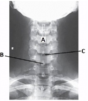 What is the projection and anatomy of interest in the figure below?   A)  AP oblique cervical spine B)  PA axial cervical spine C)  Lateral cervical spine D)  AP axial cervical spine