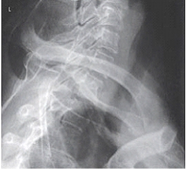 Which projection of the vertebral column is depicted in the figure below?   A)  Lateral cervical spine B)  Lateral cervicothoracic spine C)  AP axial oblique cervical spine D)  Oblique thoracic spine