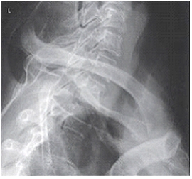 Where is the central ray centered on the patient to obtain the image below?   A)  MCP at the level of C7-T1 B)  MCP at the level of T1-T2 C)  MSP at the level of C7-T1 D)  MSP at the level of C7 -T1