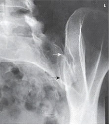 Examine this AP oblique projection image.What patient position was required to obtain this image?   A)  25 to 30 degree LPO B)  25 to 30 degree RPO C)  30 to 45 degree LPO D)  30 to 45 degree RPO
