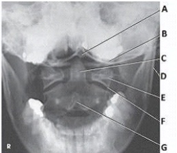 What anatomy is labeled with the letter C in the image below?   A)  Occipital base B)  Lateral mass of C1 C)  Dens of C2 D)  Body of C2