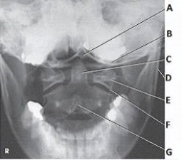 What anatomy is labeled with the letter E in the image below?   A)  Occipital base B)  Lateral mass of C1 C)  Dens of C2 D)  Body of C2