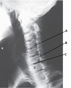 What anatomy is labeled with the letter D in the image below?   A)  T1 B)  C5 C)  C7 D)  T2