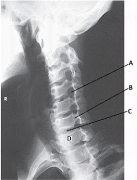 What anatomy is labeled with the letter A in the image below?   A)  Zygapophyseal joint of C4-C5 B)  Zygapophyseal joint of C5-C6 C)  Intervertebral foramen of C4-C5 D)  Intervertebral foramen of C5-C6