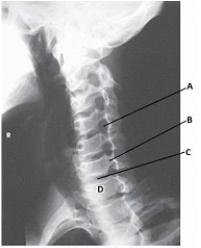 What anatomy is labeled with the letter C in the image below?   A)  Intervertebral disk space of C6-C7 B)  Intervertebral foramen of C6-C7 C)  Intervertebral disk space of C7-T1 D)  Intervertebral foramen of C7-T1