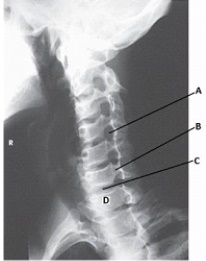 What anatomy is labeled with the letter B in the image below?   A)  Lamina of C6 B)  Pedicle of C6 C)  Lamina of C5 D)  Pedicle of C5